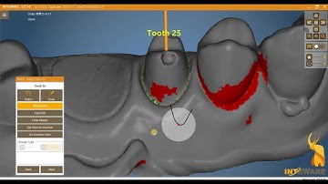 Anatomic Bridge Design