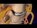 Cervical Disc Removal