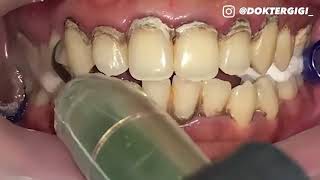 جرمگیری دندان‌