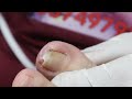 Ep_3704 Ingrown toenail removal 👣 เล็บยาวแบบนี้..เริ่มตัดยังไงดีครับ 😷 (clip from Thailand)