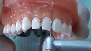 All ceramic crown tooth preparation