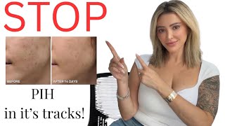 How to get rid of acne marks in 14 days!