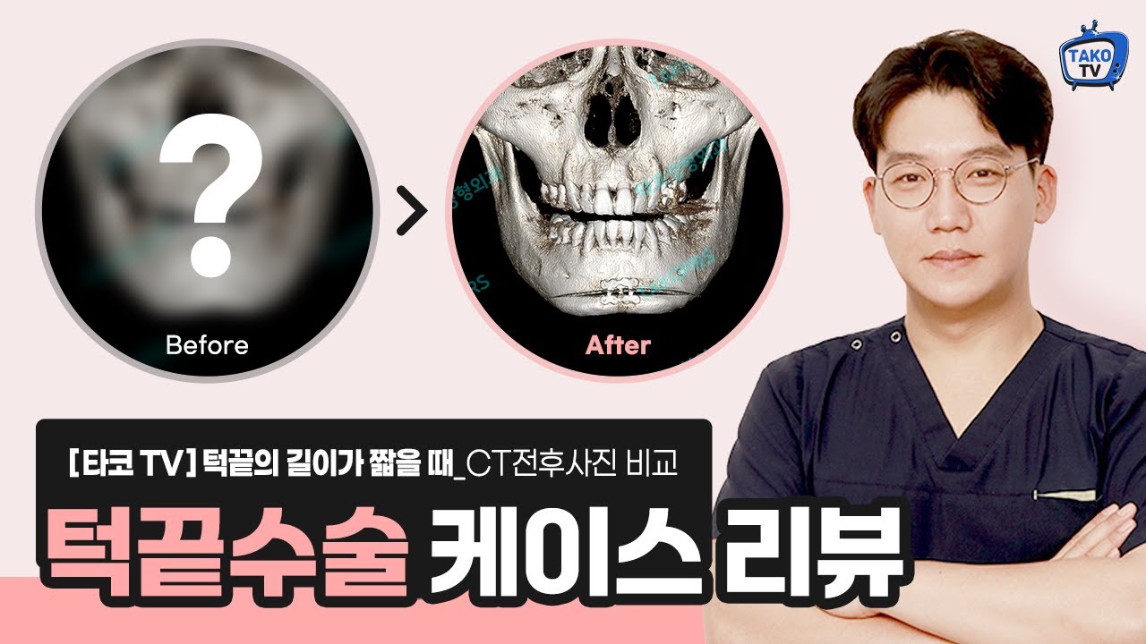 [타코TV]케이스리뷰_#01 턱끝 T절골, 길이 연장 후 시간이 지나면 어떻게 될까?(엉덩이턱, 비대칭턱 안면윤곽수술 ...
