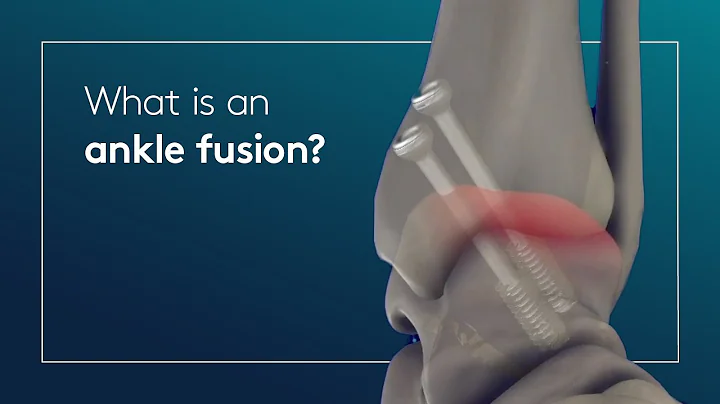 What is an ankle fusion?