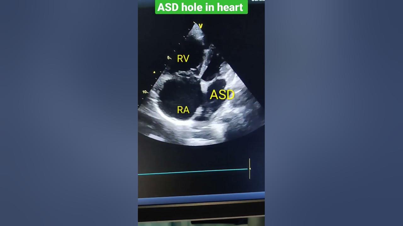 Asd hole in heart echo l asd echo shorts youtube
