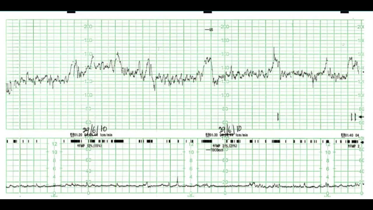 How To Read A Cardiotocography Ctg Youtube