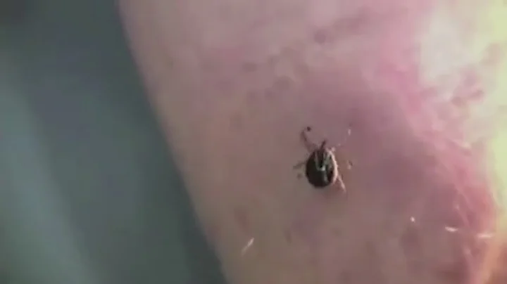 ‘Diligence is the best prevention’: Experts warn of tick-borne diseases