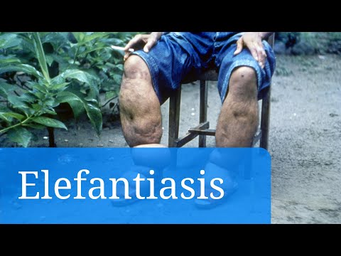 Elefantiasis o filariasis linfática: fotos e información sobre esta enfermedad