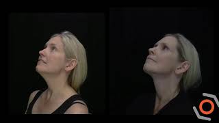 Before & After Video of Patient Having Received The MyEllevate® Procedure-  6 years post procedure!