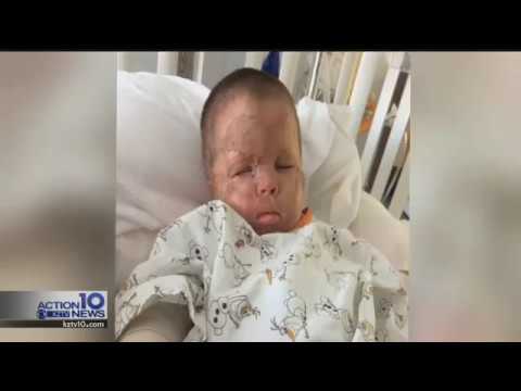 Local 3-year-old burn victim to be released from Galveston hospital