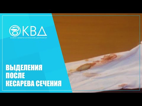 👩 1473  Выделения после кесарева сечения