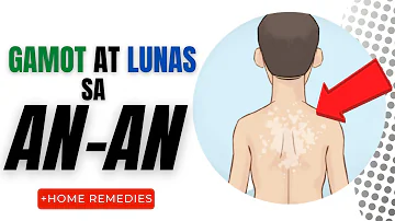 GAMOT at LUNAS sa AN-AN | Mga Sanhi, Sintomas at Paano Mawawala, Home Remedies, Creams