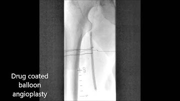 Jetstream and drug coated balloon for popliteal in-stent restenosis
