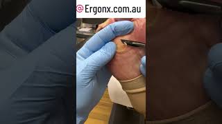 Podiatrist's Guide to Pain-Free Corn &amp; Callus Removal #FootCare #Podiatry