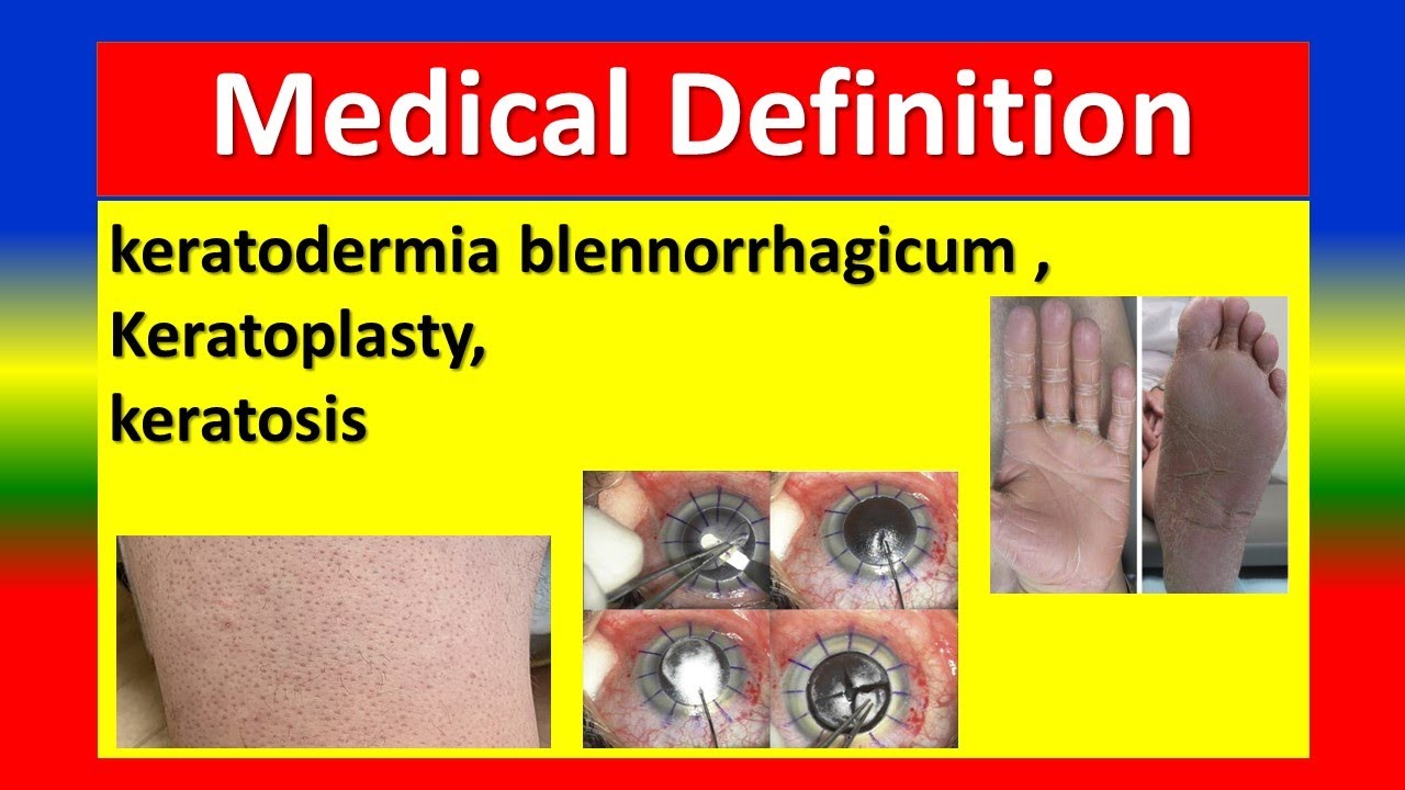 MEDICAL DEFINITION keratodermia blennorrhagicum ,Keratoplasty