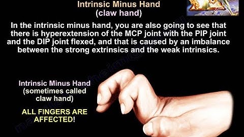 Intrinsic Minus & Intrisic Plus Hand - Everything You Need To Know - Dr. Nabil Ebraheim