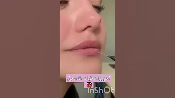 بنت تتحول من جميلة الي قبيحة بسبب عمليات الجميل Fyp 