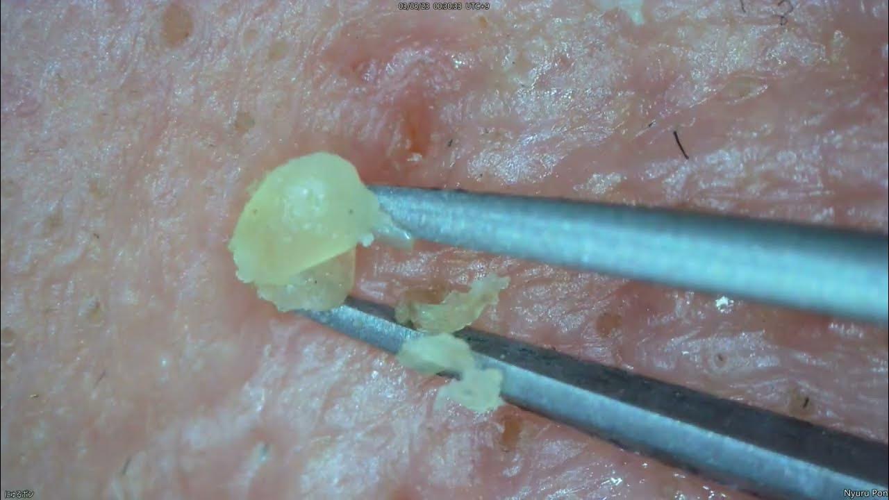 0166 keratin plug removal nose YouTube