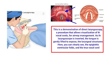 Direct Laryngoscopy and it