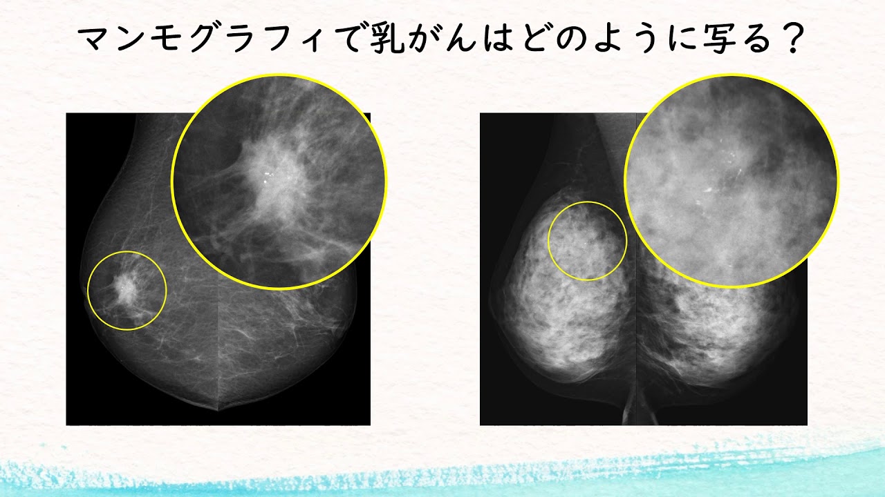 マンモグラフィ検査でわかる「高濃度乳房」ってどんなもの？ - YouTube
