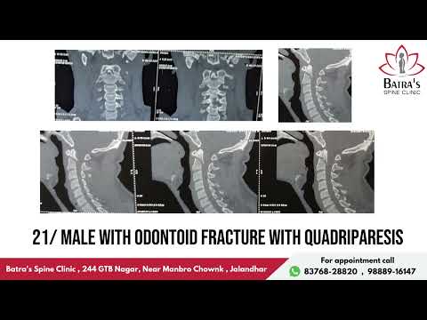 Video thumbnail: Patient testimonial – Dr Sahil Batra