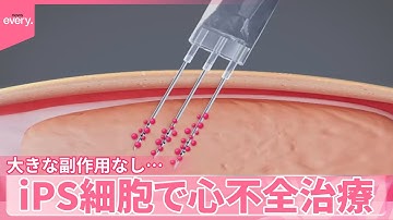【世界初の治験】心臓の機能が回復  iPS細胞で心不全治療  大きな副作用なし…