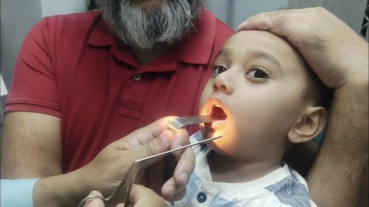 removal-of-foreign-body-from-throat-youtube
