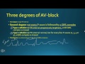 Avblock 3 minute medicine