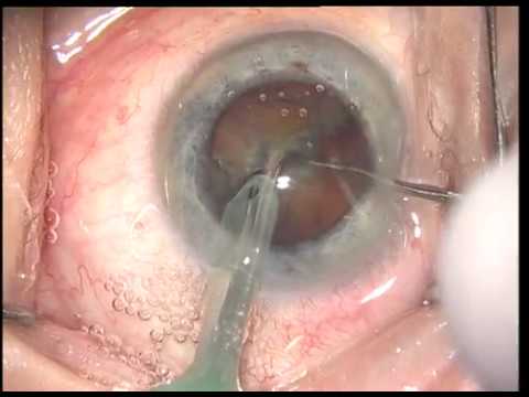 Quick Chop Cataract Extraction, operacija katarakte z minimalno invazivno tehniko Vladimir Pfeifer