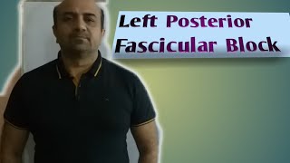 Ecg....left Posterior Fascicular Blocklpfb