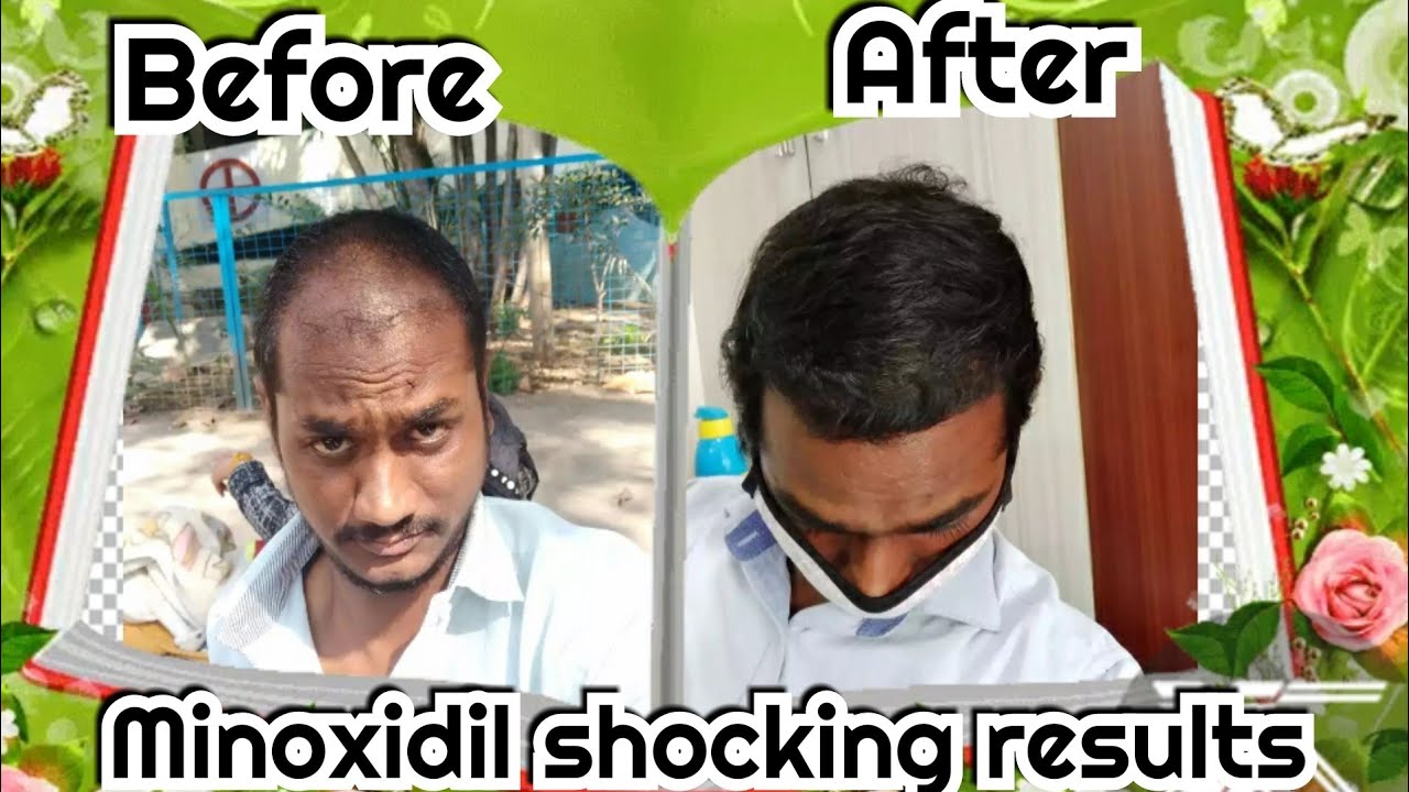 Morr f 3 side effects