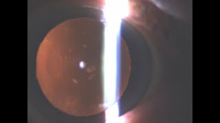 routine phaco chop cataract surgery