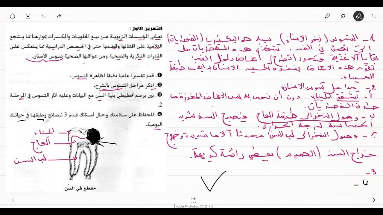 تمرين حول تسوس الاسنان للعلوم الطبيعة السنة الرابعة متوسط