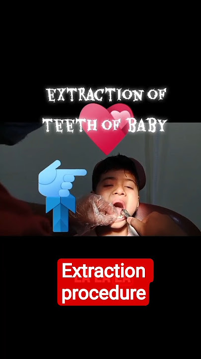 Extraction procedure#shortvideo #dentist #shortsfeed #dentistry #pediatric dentitry #dentistry