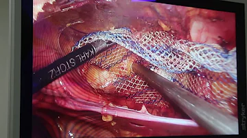 Quanto custa a tela para cirurgia de hérnia?