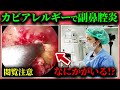 鼻づまりや慢性副鼻腔炎が治らない方へ。実は“カビアレルギー”が原因かもしれません【アレルギー性真菌性副鼻腔炎】