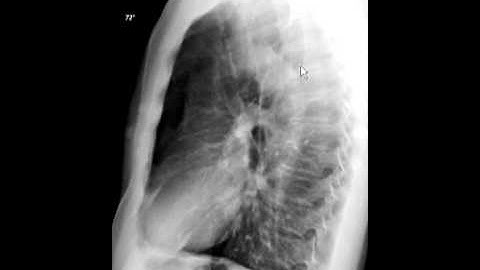 How to read a lateral chest x-ray