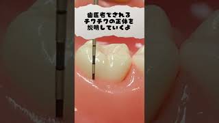 歯医者でされるチクチクの正体とは？！(歯茎は模型です)