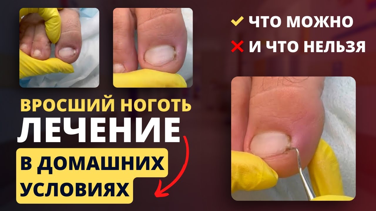 Вросший ноготь в домашних условиях / Лечение вросшего дома / Что можно ...