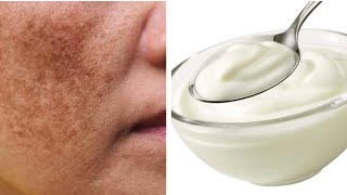 CIILAJI WAJIGA FOR HYPERPIGMENTATION