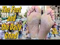 The Feet and the Daily Grind: Trimming Severe Calluses