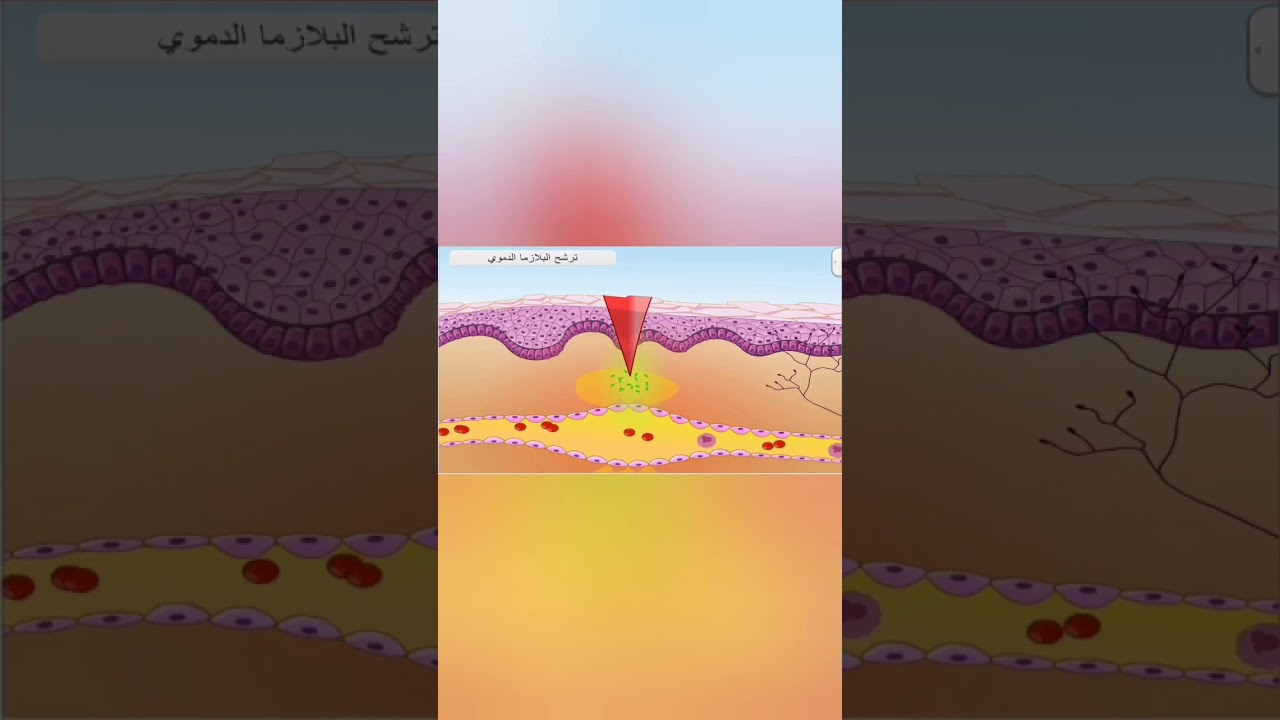 التفاعل الالتهابي