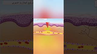 التفاعل الالتهابي