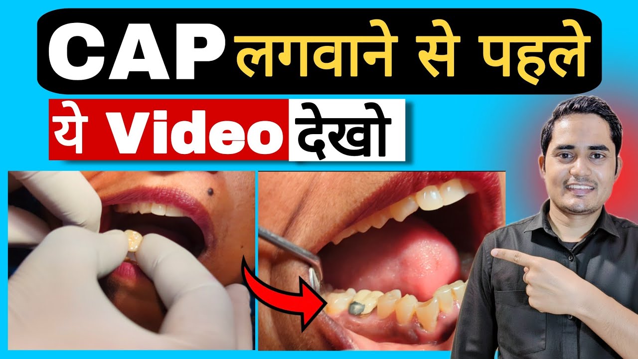 Dant Me Cap Kaise Lagate Hain? Tooth Capping After Root Canal ! - YouTube
