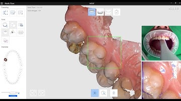 EN How to scan interproximal