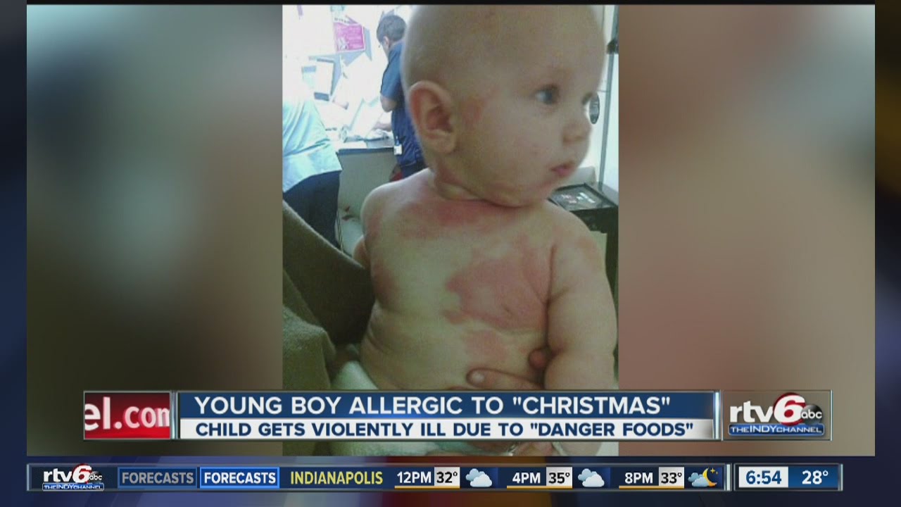 Meet the little boy who is allergic to Christmas YouTube