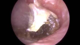Hard and Impacted Ear Wax removed from Ear Canal and Eardrum - #337