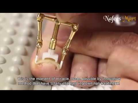 Ingrown toenail removal treatment - YouTube
