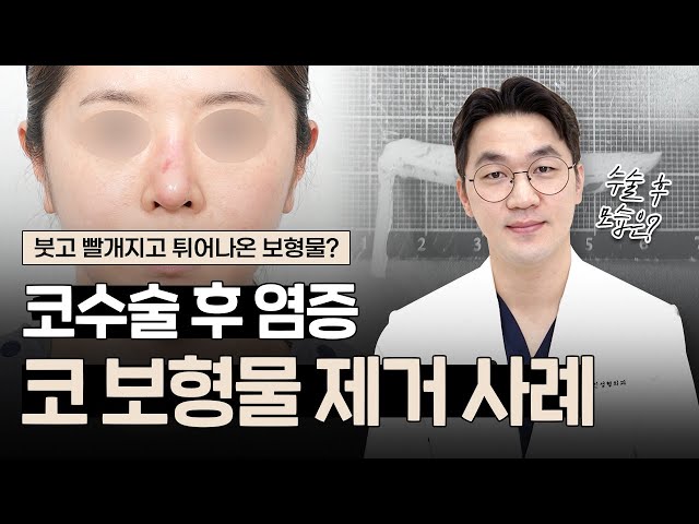 코수술 후 염증으로 콧대와 코끝이 붓고 빨개짐,뚫고 나온 보형물?!😮｜실제 사례로 보는 코 실리콘, 전체제거 수술 후기｜염증일까 걱정된다면? 필수시청!📺