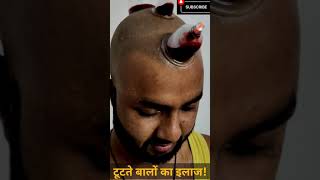 #shorts | Hijama for hair fall | 2022